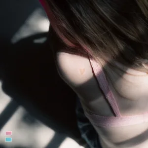 Birthmark