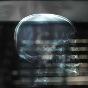 Concussion